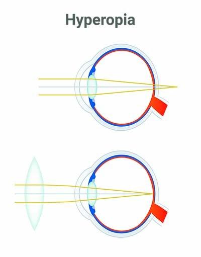 Схема фокусировки глаза при дальнозоркости